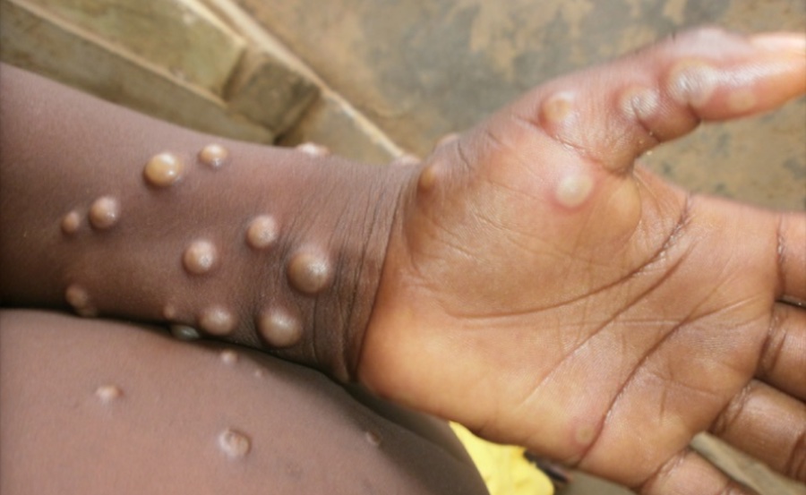 Sri lankan first monkeypox patient is reported