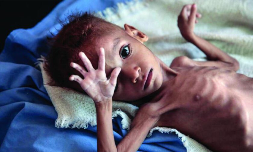 පාසල් දරුවන් පස් දෙනෙකුගෙන් එක් අයෙක් මන්දපෝෂණයෙන්!